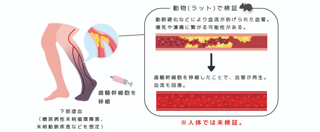 歯髄幹細胞が血管と神経の再生を後押し―下肢虚血と歯髄再生モデル動物で効果―