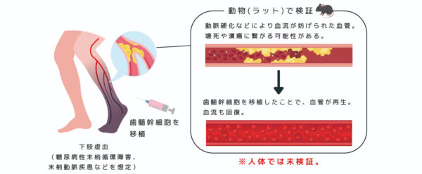 歯髄幹細胞が血管と神経の再生を後押し―下肢虚血と歯髄再生モデル動物で効果―