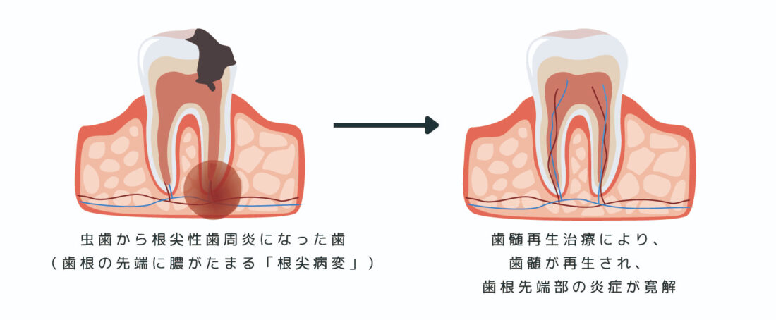 根尖性歯周炎における歯髄再生に成功―歯根先端部の炎症も寛解―