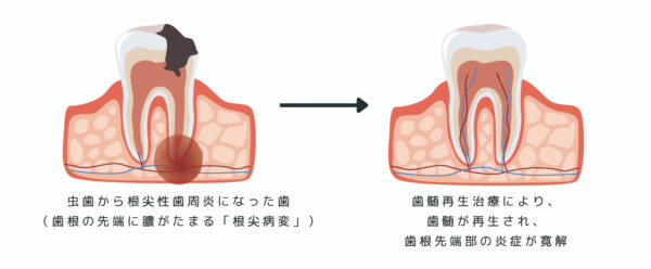 根尖性歯周炎における歯髄再生に成功―歯根先端部の炎症も寛解―