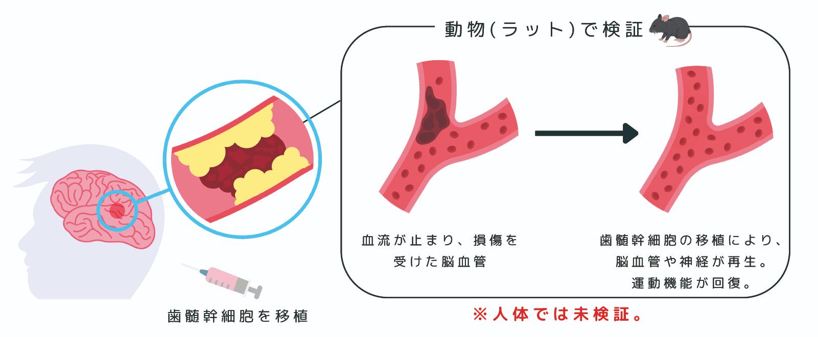 歯髄幹細胞が手足の神経を再生？末梢神経損傷に対する新たな治療法の