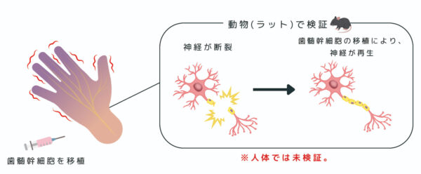 歯髄幹細胞が脳梗塞を回復させる？脳血管と脳神経の再生
