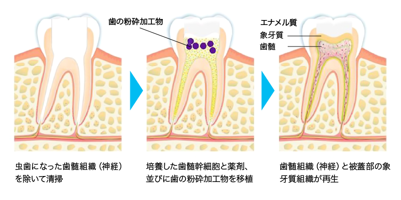 象牙質再生治療について