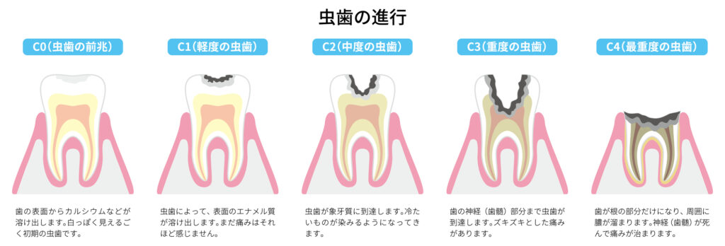 虫歯の進行