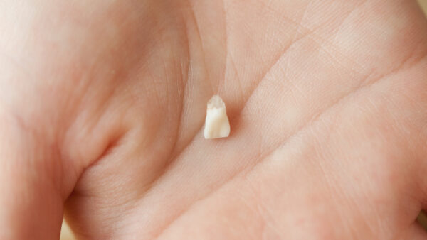 抜歯した乳歯の保存方法とは？将来活用できる方法もご紹介