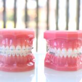 矯正治療で抜歯は必要？矯正で抜歯した歯を活用できる方法とは