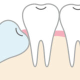 親知らずはなぜ抜く必要があるの？抜歯をお勧めするケースとは？