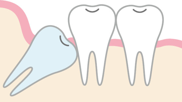 親知らずはなぜ抜く必要があるの？抜歯をお勧めするケースとは？