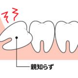 親知らずが原因の痛みとその対策とは