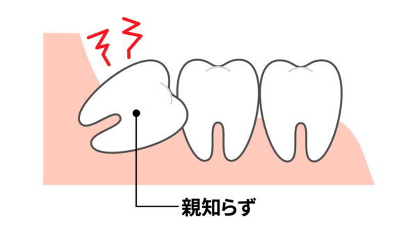 親知らずが原因の痛みとその対策とは