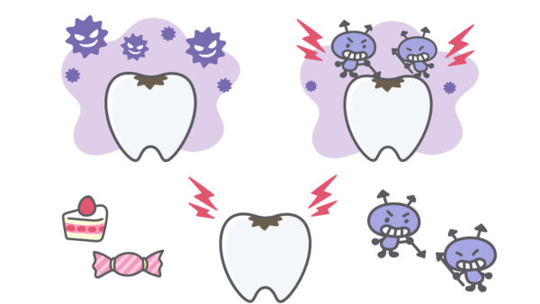 虫歯になりやすい人の特徴は？虫歯が悪化した時に歯の寿命を延ばすには