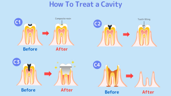 C3の虫歯は根管治療をする？根管治療で歯の神経を失いたくない場合は？