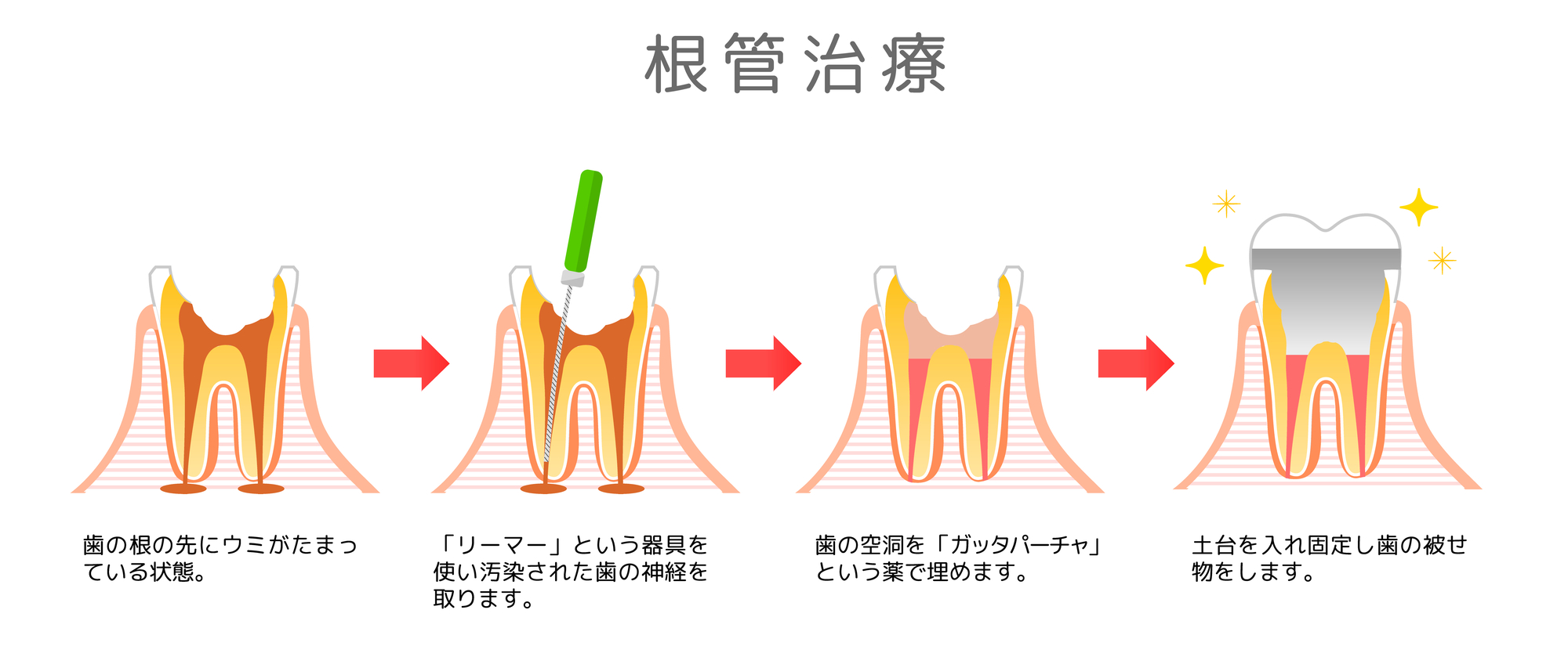 C3の虫歯は根管治療をする?根管治療で歯の神経を失いたくない場合は? | アエラスバイオコラムサイト